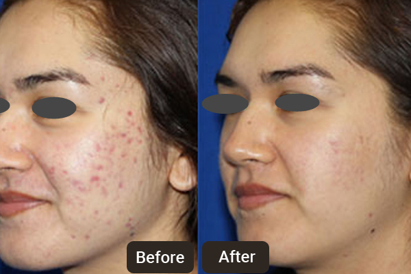 Cosmetic Dermatology Clinic in Chandigarh