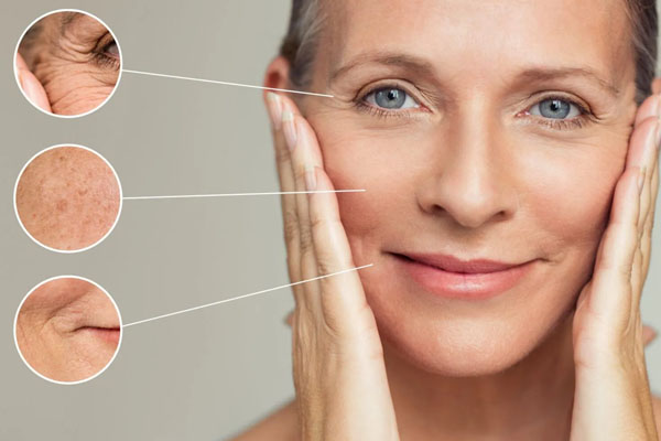 Thread Lifts: Anti-Aging Treatments by Dr. Sheenam in Chandigarh
