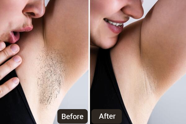 Laser Hair Removal Clinic in Chandigarh