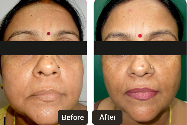 Anti-aging Treatments Chandigarh