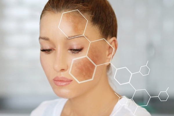 Pigmentation Removal: How to Treat Pigmentation, Sun Spots, Age Spots and Melasma 