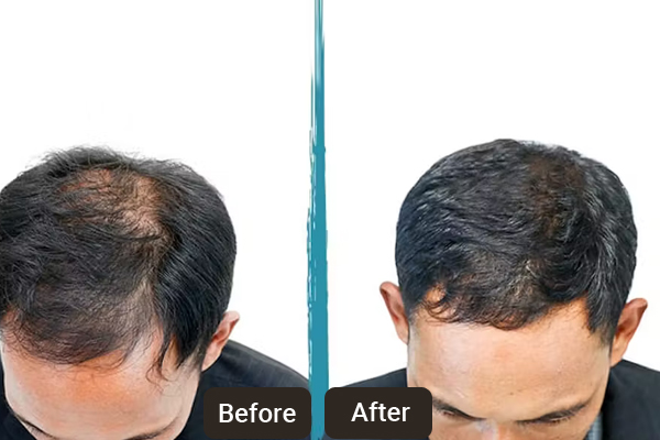 PRP Hair and Skin Treatment Chandigarh