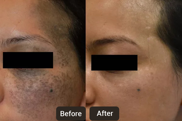 Laser Skin Treatments in Chandigarh